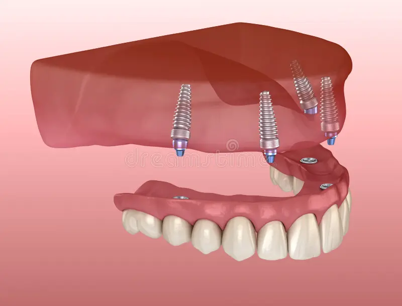 Dentures El Paso - Dyer Dental Care