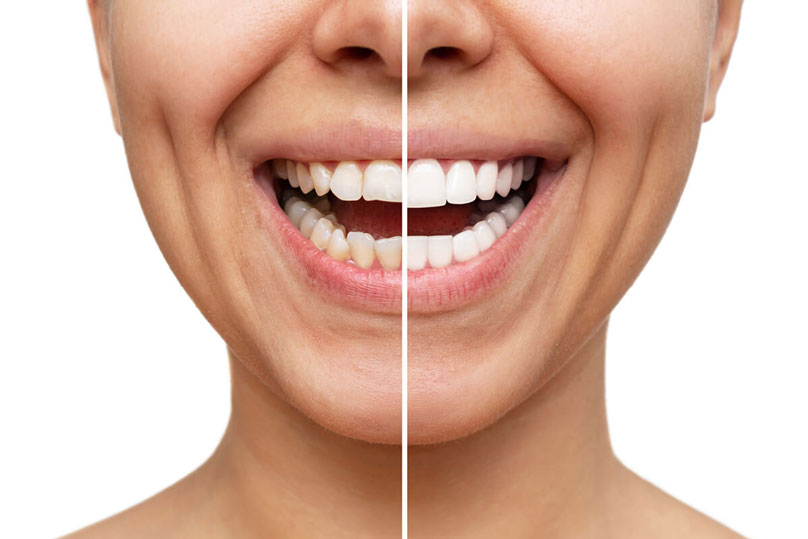 Your Step-by-Step Guide to Getting Dental Veneers - Dyer Dental Care